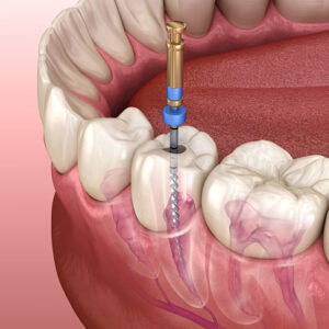 Endodontics