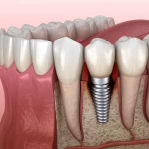 Periodontics and Implant Dentistry